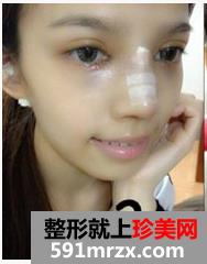韩式纳米仿真隆鼻术+韩式无痕开眼角 大家说我像混血儿