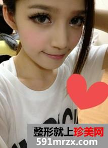 韩式纳米仿真隆鼻术+韩式无痕开眼角 大家说我像混血儿