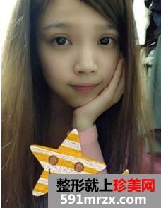 韩式纳米仿真隆鼻术+韩式无痕开眼角 大家说我像混血儿