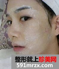 激光,美容,嫩肤,美白,前后,对比,效果,图片,恢复,过程,分享