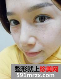 激光,美容,嫩肤,美白,前后,对比,效果,图片,恢复,过程,分享