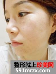 激光,美容,嫩肤,美白,前后,对比,效果,图片,恢复,过程,分享