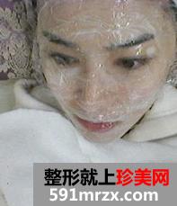 激光,美容,嫩肤,美白,前后,对比,效果,图片,恢复,过程,分享