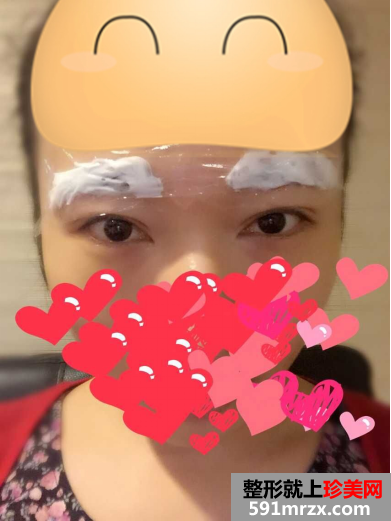 苏州维多利亚整形医院做的韩式半永久纹眉效果