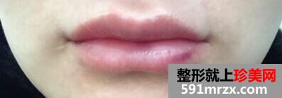 自体,脂肪,移植,丰唇,前后,对比,效果,图片,恢复,过程,分享