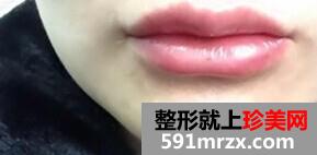 自体,脂肪,移植,丰唇,前后,对比,效果,图片,恢复,过程,分享