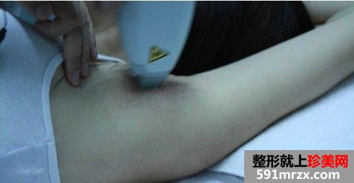 上海,九院,激光脱毛,恢复,过程,前后,对比,效果图