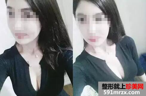 水滴型假体隆胸 一次增大2个罩杯