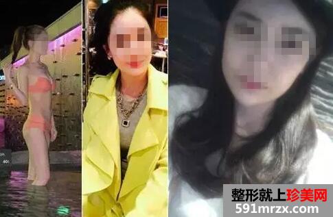 水滴型假体隆胸 一次增大2个罩杯