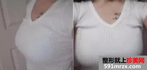水滴型假体隆胸 一次增大2个罩杯