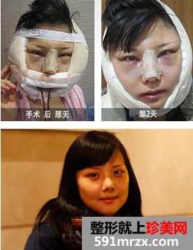 颧骨颧弓综合整形术前后效果真实案例图和恢复过程记录