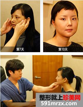 颧骨颧弓综合整形术前后效果真实案例图和恢复过程记录