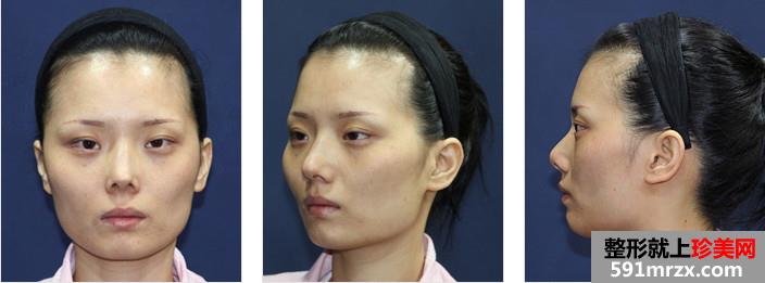颧骨颧弓综合整形术前后效果真实案例图和恢复过程记录
