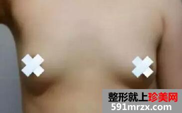 曼托假体隆胸5个月了 我是公认的美女大小姐