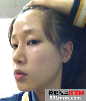 自锁托槽,牙齿,矫正,前后,对比,效果,图片,恢复,过程