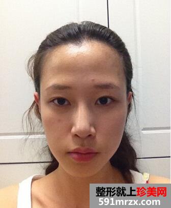 自锁托槽,牙齿,矫正,前后,对比,效果,图片,恢复,过程