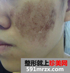 像素激光去痘坑 我的脸上光滑了