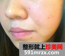 像素激光去痘坑 我的脸上光滑了
