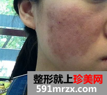 像素激光去痘坑 我的脸上光滑了