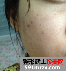 像素激光去痘坑 我的脸上光滑了