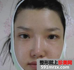 怎么样,才能,减双下巴,可以,看看,我的,蜕变,过程