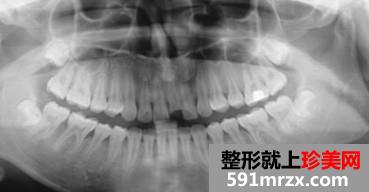 种植牙,前后,对比,效果,图片,恢复,过程