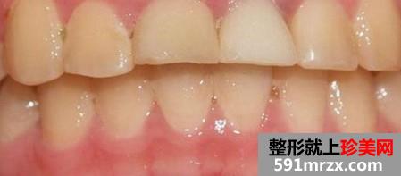种植牙,前后,对比,效果,图片,恢复,过程