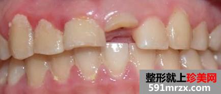 种植牙,前后,对比,效果,图片,恢复,过程