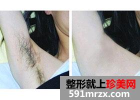 青岛,即墨,仁和,医院,激光,脱腋毛,看起来,很自然
