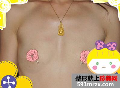 感谢es假体隆胸 让我拥有迷人乳沟