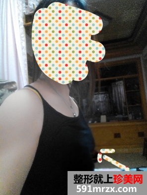自体脂肪干细胞丰胸,胸围c罩杯