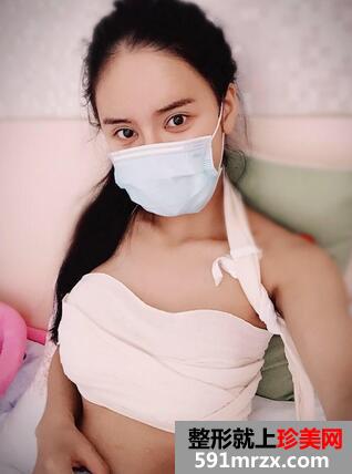 曼托妙桃琴面假体隆胸术前后对比照和恢复过程分享