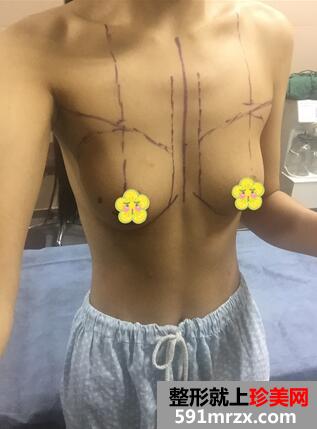 曼托妙桃琴面假体隆胸术前后对比照和恢复过程分享