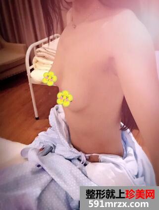 曼托妙桃琴面假体隆胸术前后对比照和恢复过程分享