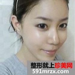 做了自体脂肪移植，快来看看我的惊艳蜕变