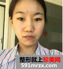 我的膨体隆鼻+双眼皮整形之路