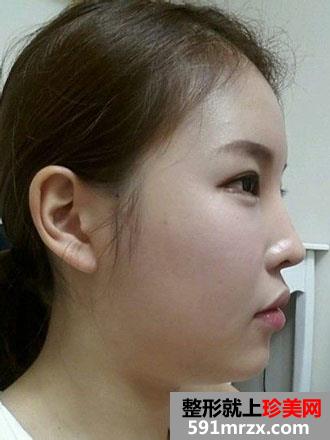 自体脂肪,丰苹果肌,手术,恢复,过程,前后,对比,效果图