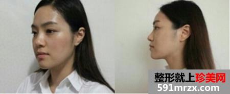 分享双鄂手术后变精致小脸