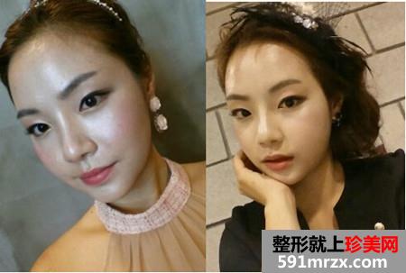 分享双鄂手术后变精致小脸