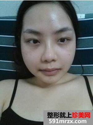 分享双鄂手术后变精致小脸