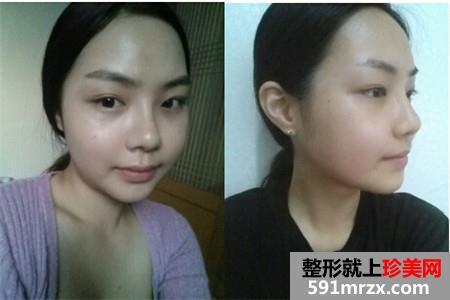 分享双鄂手术后变精致小脸