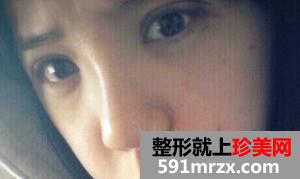 双眼皮开眼角+假体隆鼻 整个人气质提升不少