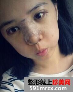 双眼皮开眼角+假体隆鼻 整个人气质提升不少