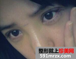 双眼皮开眼角+假体隆鼻 整个人气质提升不少