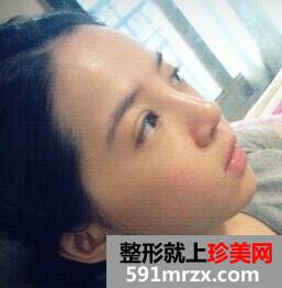 双眼皮开眼角+假体隆鼻 整个人气质提升不少