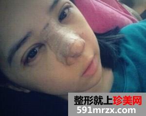 双眼皮开眼角+假体隆鼻 整个人气质提升不少
