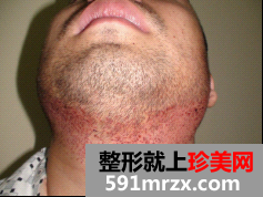 因为想找女朋友 在北京做了无痕植发