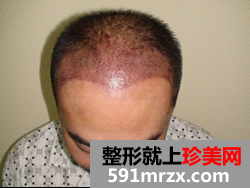 因为想找女朋友 在北京做了无痕植发