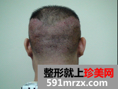 因为想找女朋友 在北京做了无痕植发
