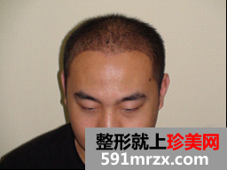 因为想找女朋友 在北京做了无痕植发